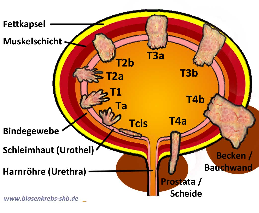 Lebenserwartung Bei Blasenkrebs Mit Metastasen fity.club